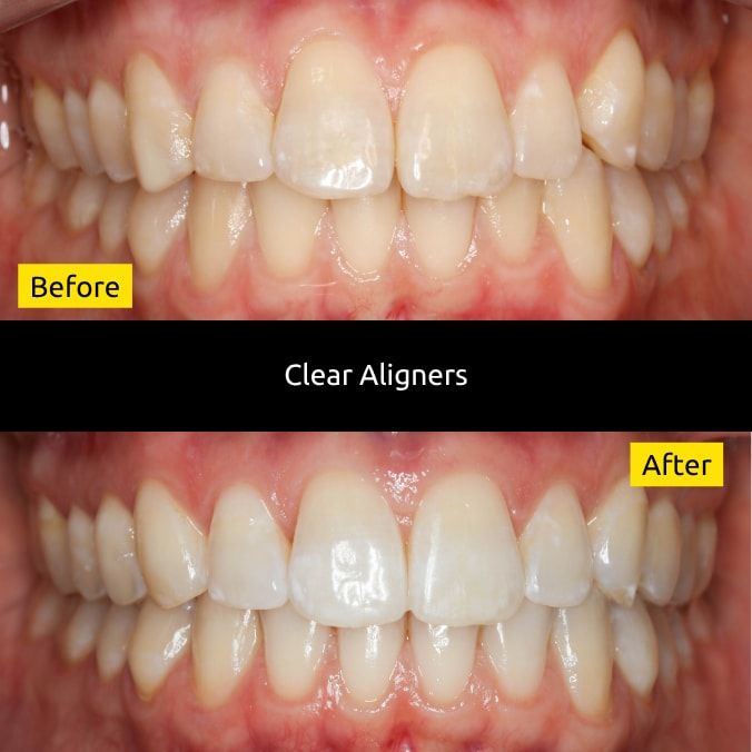 Before and after clear aligners treatment at SmileUp
