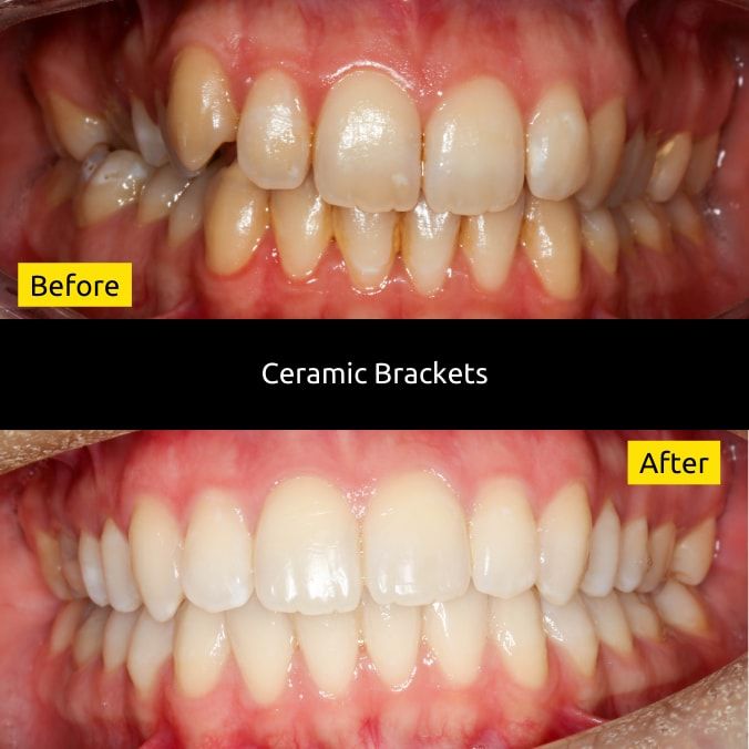 Before and after ceramic braces treatment at SmileUp