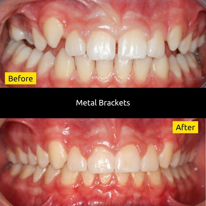 Before and after metal braces treatment at SmileUp