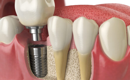 Dental implants: The No.1 Solution To replacing A Missing Tooth