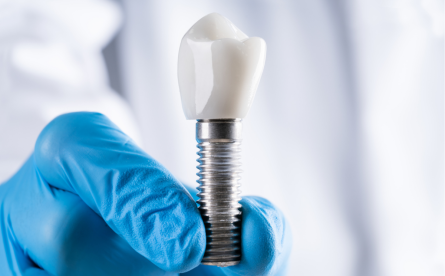 How Dental Implants Prevent Jawbone Loss