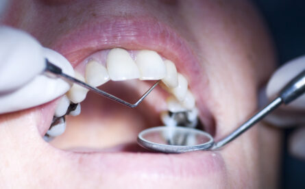 Looking To Replace An Old Metal Filling Or A Crown? Here’s Everything You Need To Know