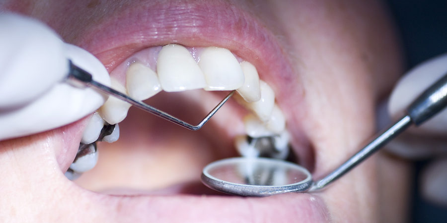 Looking To Replace An Old Metal Filling Or A Crown? Here's Everything You  Need To Know - Smile Up Dental