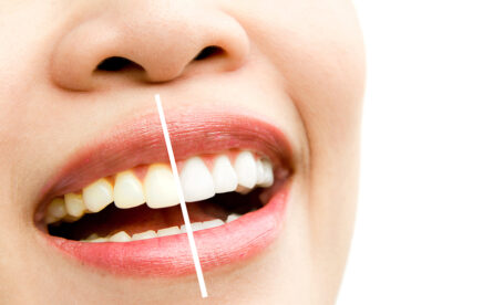 The Consequences Of Illegal Tooth Whitening