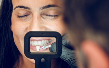 Veneers – Their Origins And Why They’re Such A Sought-After Cosmetic Treatment