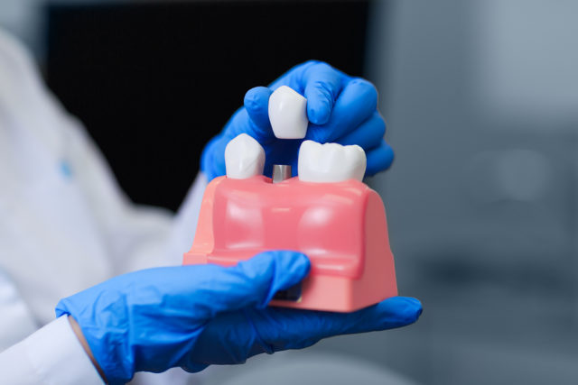 Doctor Holding Model Of Teeth With Dental Implant, Closeup. Toot