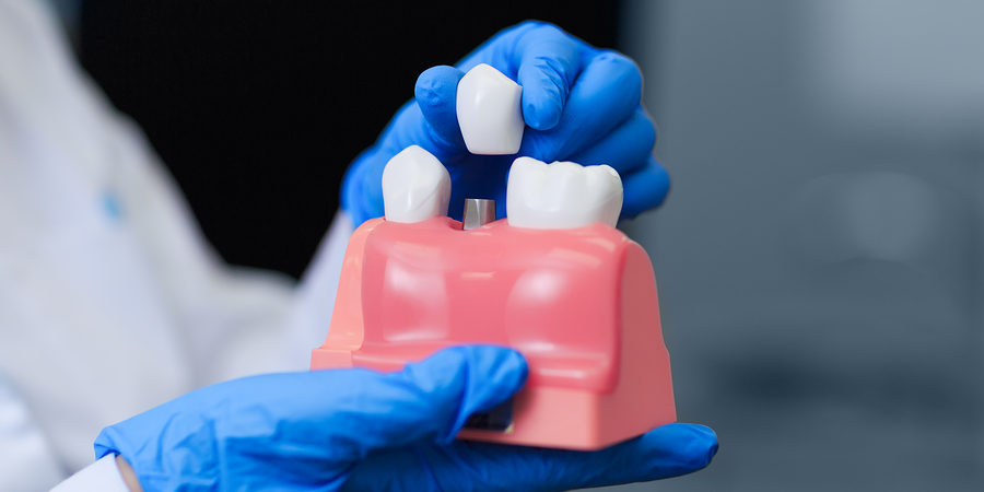Doctor Holding Model Of Teeth With Dental Implant, Closeup. Toot