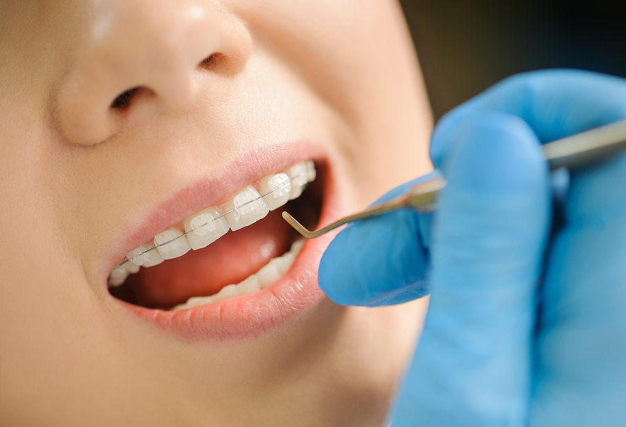 Everything You Need To Know About Ceramic Braces - Smile Up Dental