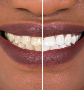 Close-up Detail Of Smiling Woman Teeth Before And After Whitening