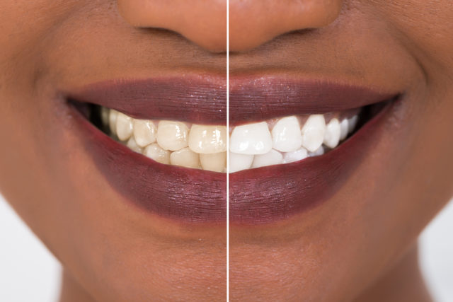 Close-up Detail Of Smiling Woman Teeth Before And After Whitening