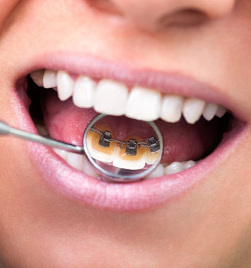 woman showing  invisible lingual braces on dental mirror