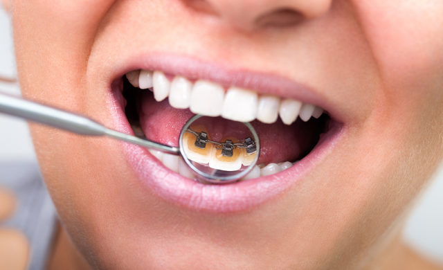 woman showing  invisible lingual braces on dental mirror