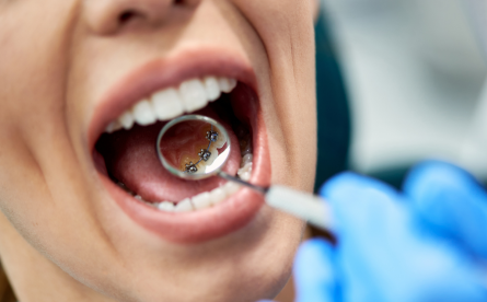 5 Benefits Of Lingual Braces