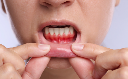 Gum Disease May Be Linked To Alzheimer’s Development According To New Study