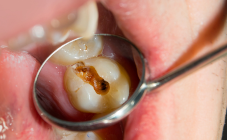 Why Replace Old Fillings With Composite Fillings?