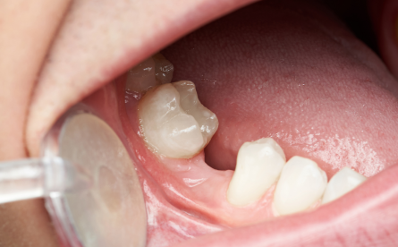 What Is Resorption And How Does It Affect A Missing Tooth?