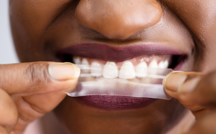 Illegal vs Legal Teeth Whitening – Know The Difference