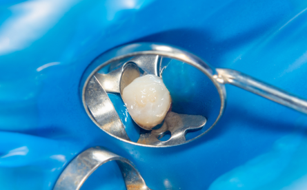 Top 5 Benefits Of Composite White Fillings