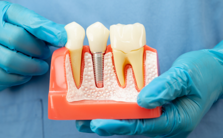 Why Dental Implants Are Your Jawbone’s Best Friend