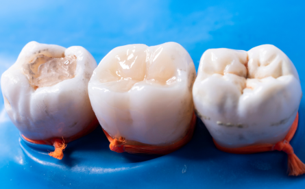 White Fillings – Aesthetic Fillings That Blend With Your Smile