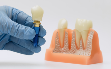 Dental Implants – Restoring Smiles To 100%