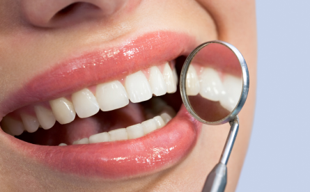Composite Bonding – Available At Smile Up
