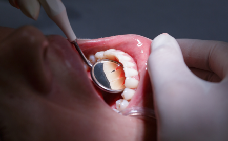 A Third of People in the UK have Never Visited a Dental Hygienist