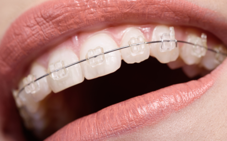 Everything You Need To Know About Ceramic Braces