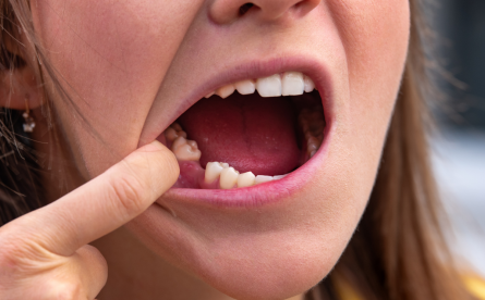 Missing Teeth: Why It’s Essential To Address The Issue ASAP