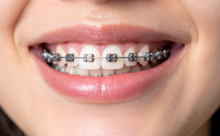 Free Orthodontic Consultations Offer At Smile Up
