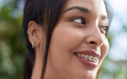 Adult Braces in Lewisham & Greenwich: Types, Costs and Discreet Options